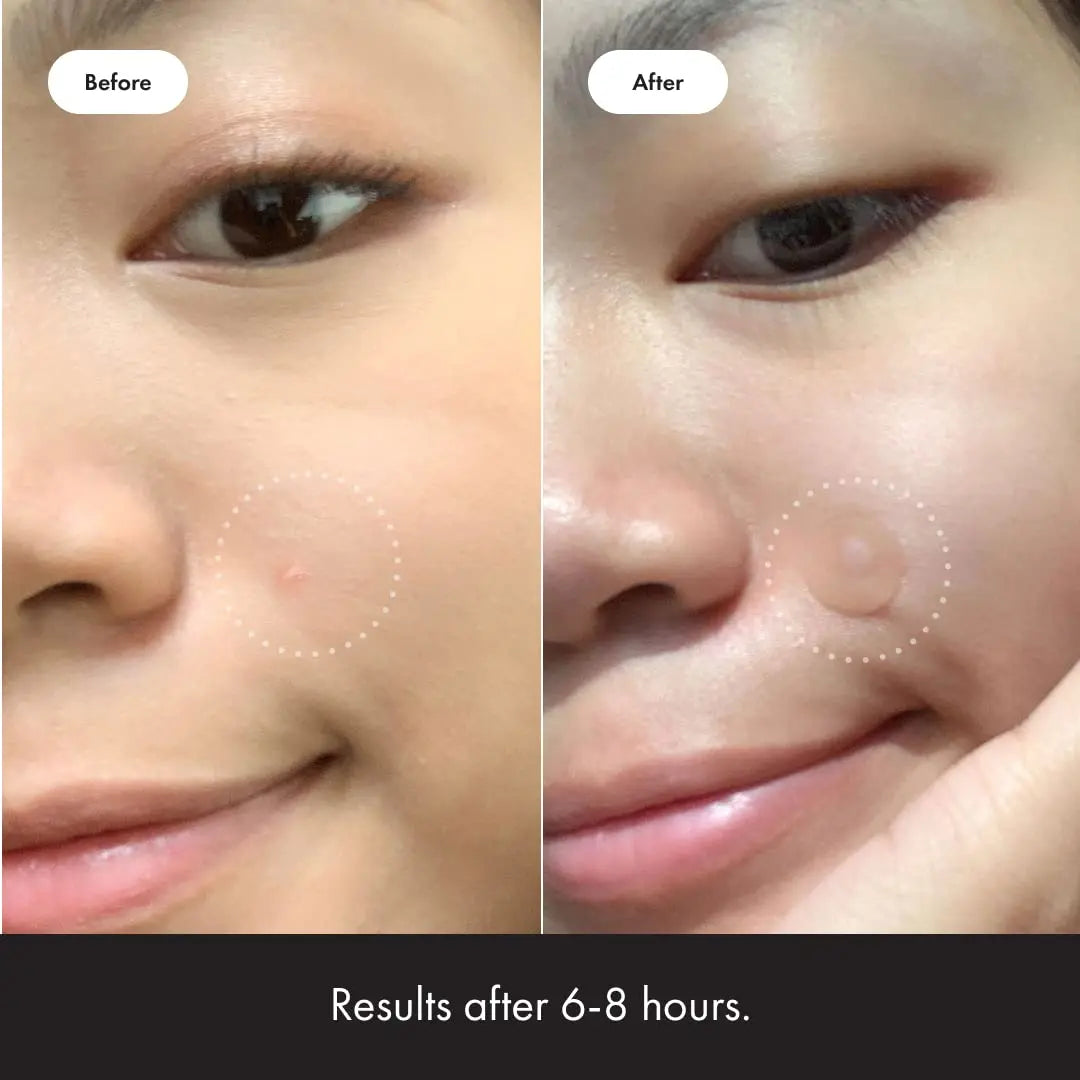 Acne Patch Hub